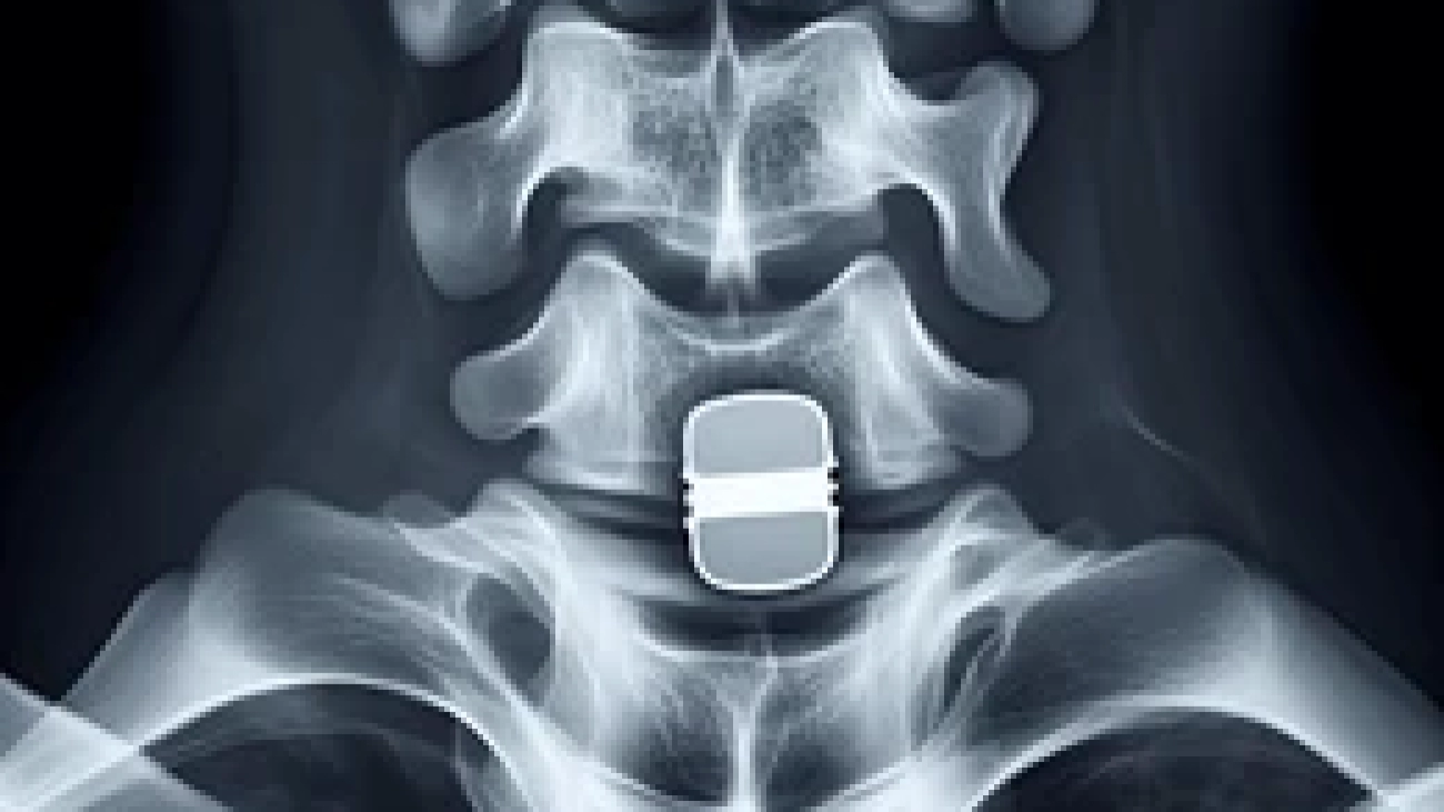 xray-neck-chip-second-vertebre-260nw-2457526195